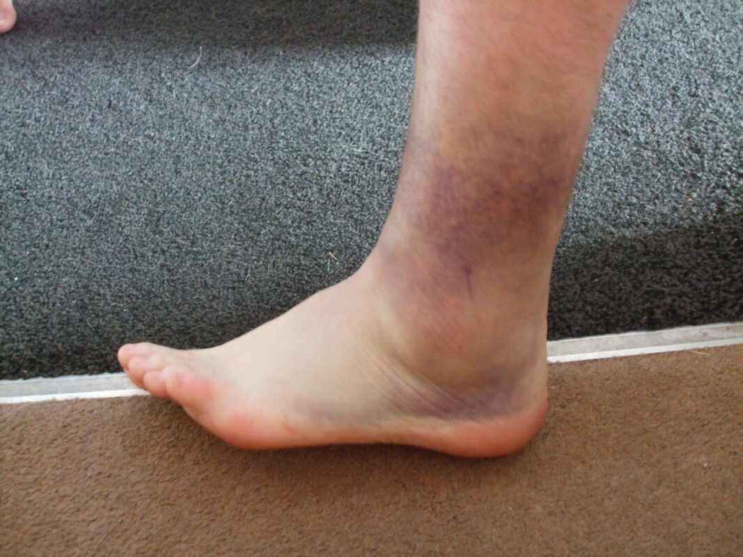 Having helped many people with such injuries and dealing with some horrific ankle injuries one in particular springs to mind. (My client has given his consent for this to be published) “Whilst in my garden, attending to my roses I slipped and lost my footing .I went one way and my ankle went the other .The pain was excruciating, I managed to get into my house and applied “ICE” to attempt to keep the swelling down.