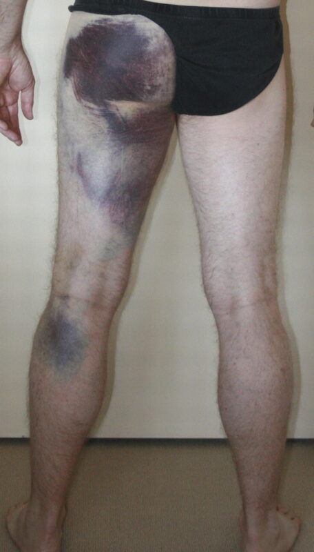 The torn hamstring is a common athletic injury. This does not mean that it only happens to athletes’ though you have probably heard it mentioned during the Olympics. It happens to lots of people who start off with good intentions to do sports, but not with the right training or backing.