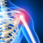 Previous shoulder issues treated only with rest and medication will not properly rehabilitate and are prone to re-injury until properly conditioned by corrective exercise, therapy treatment, Sports Massage and Neuromuscular Therapy and manipulation . Exercises alone will not gain full pain free restoration and quality of life.