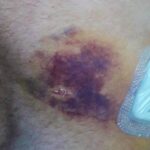 There is a time for Painkilling Relief and a Time to Manage Pain and Recovery