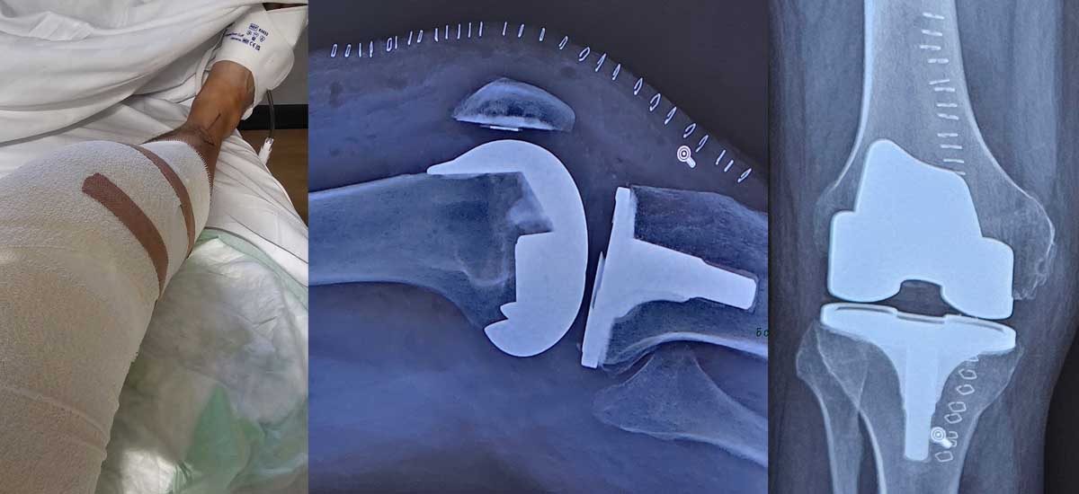 Spire Hospital Knee Operation